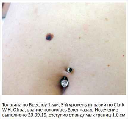 Рисунок 2. Поверхностно-распространяющаяся меланома брюшной стенки у женщины 34 лет