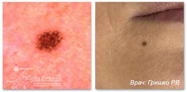 Атипичная поверхностная внутриэпидермальная пролиферация меланоцитов, врач: Гришко Роман Васильевич