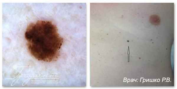 Пигментная меланома кожи, врач: Гришко Роман Васильевич