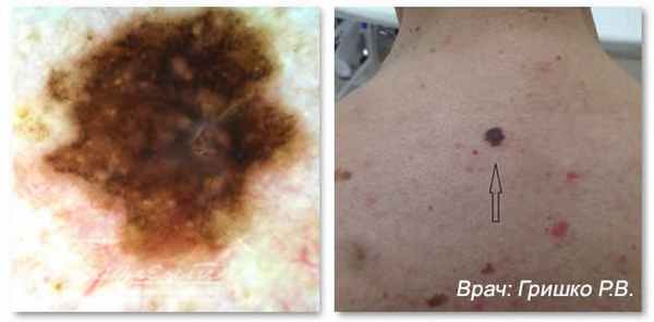 Поверхностно распространяющаяся меланома кожи без изъязвления, врач: Гришко Роман Васильевич