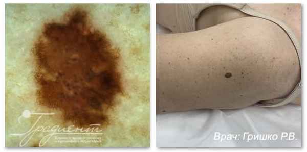 Лентигинозная меланома кожи, врач: Гришко Роман Васильевич