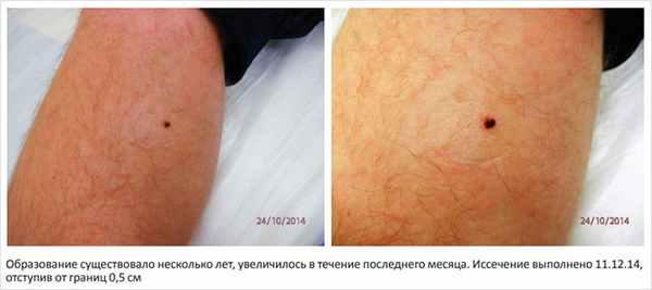 Рисунок 5, 6. Меланома правой голени у мужчины 34 лет, 2-й уровень инвазии по Кларку, толщина по Бреслоу 0,75 мм
