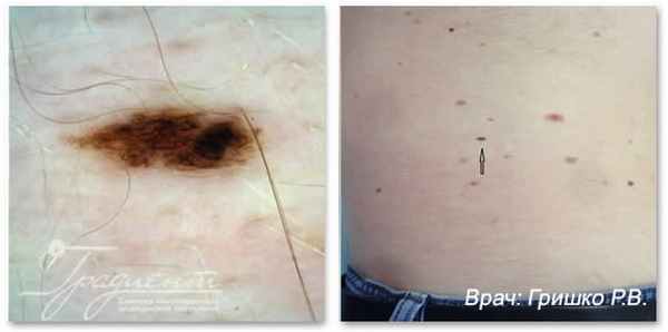 Меланома кожи в фазе горизонтального роста, врач: Гришко Роман Васильевич