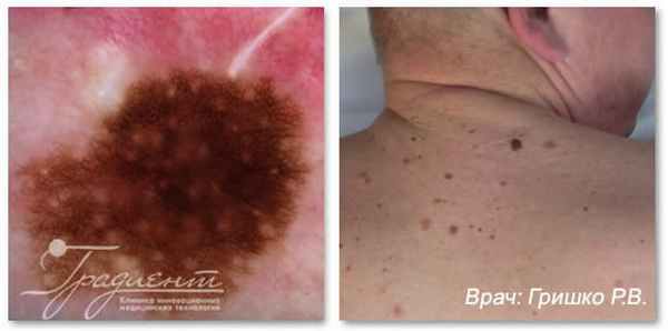 Лентигинозная меланома кожи в фазе горизонтального роста, врач: Гришко Роман Васильевич