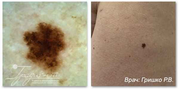 Поверхностное, атипичное меланоцитарное новообразование кожи, врач: Гришко Роман Васильевич