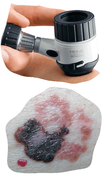 Эпилюминесцентная дерматоскопия