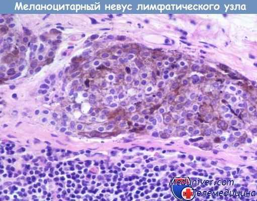 Невус лимфатического узла