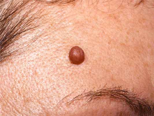 Что такое невусы