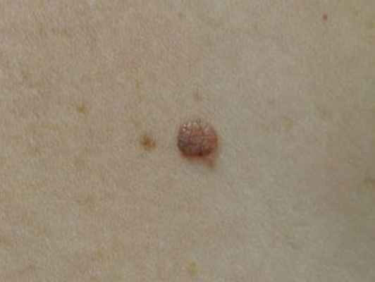 На фото папилломатозный невус, сложный меланоцитарный, гладкий.