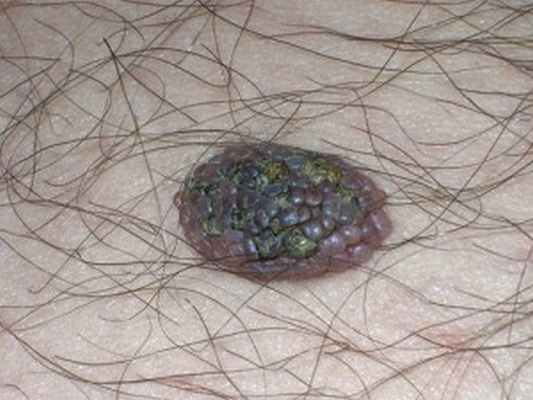 Папилломатозный невус с сосочковой поверхностью, темными корочками и чешуйками.