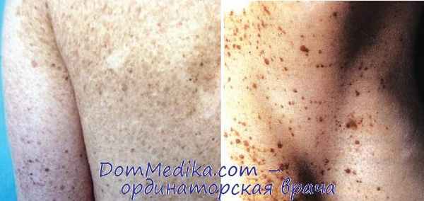 Пятнистый невус