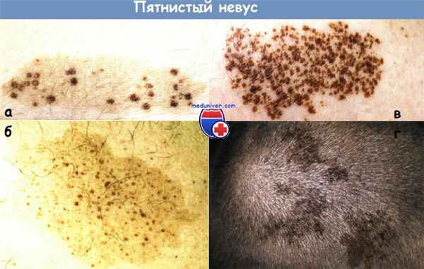Невус пятнистый