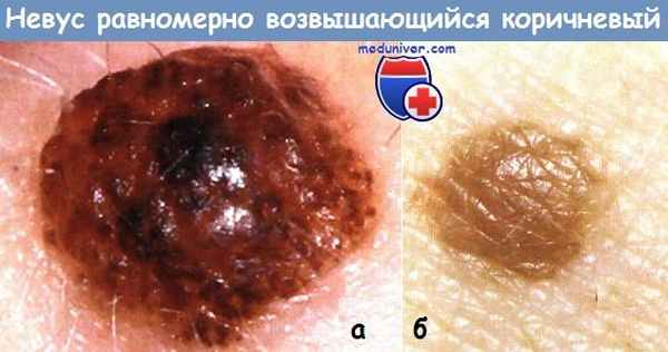 Невус равномерно возвышающийся коричневый
