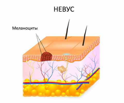 Удаление невуса