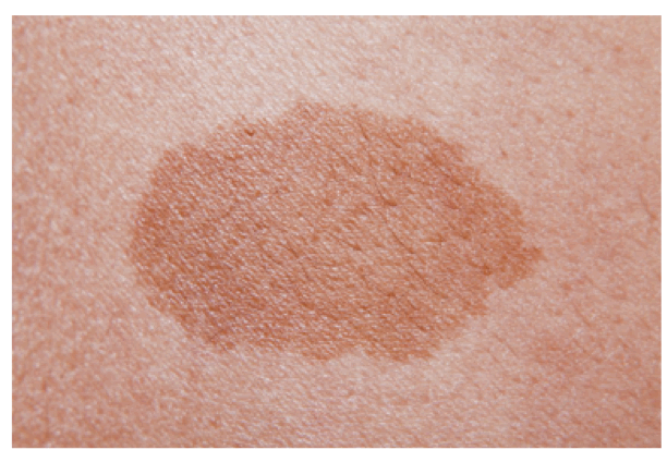 родинка, врожденная родинка