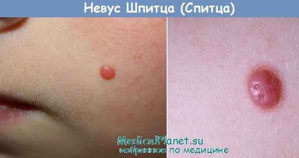 Невус Шпиц - Спитц