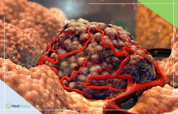 Симптомы нейрофибоматоза, осложнения после нейрофиброматоза