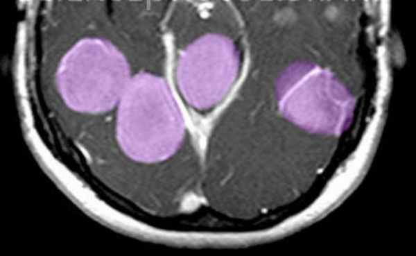 нейрофиброматоз в цвете