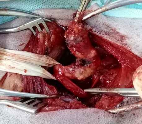 опухоль периферических нервов: после операции