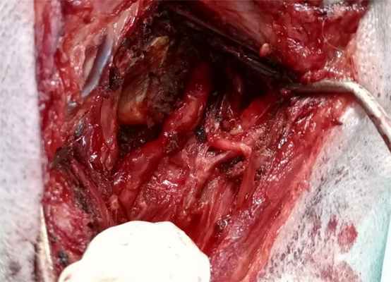 опухоль периферических нервов: после удаления