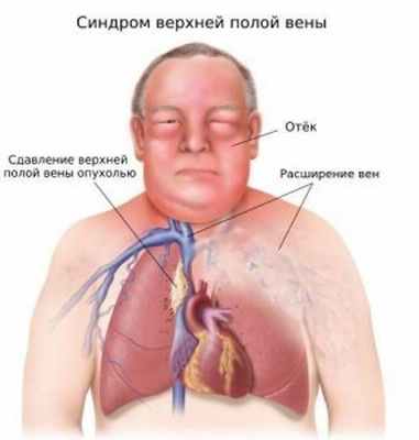 Синдром верхней полой вены