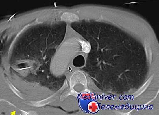 нейрофиброма средостения