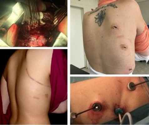 торакотомия и торакоскопия