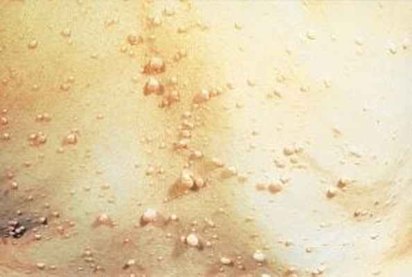 Нейрофиброматоз (нейрофиброма)