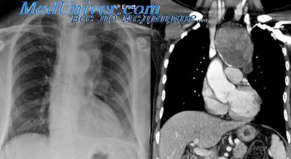 опухоли средостения