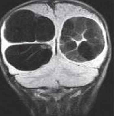 эхинококк головного