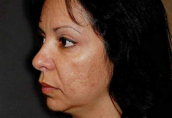 старческие пятна на лице