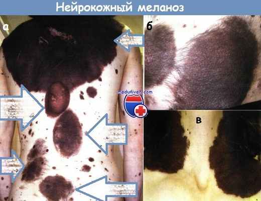 Нейрокожный меланоз - меланобластоз