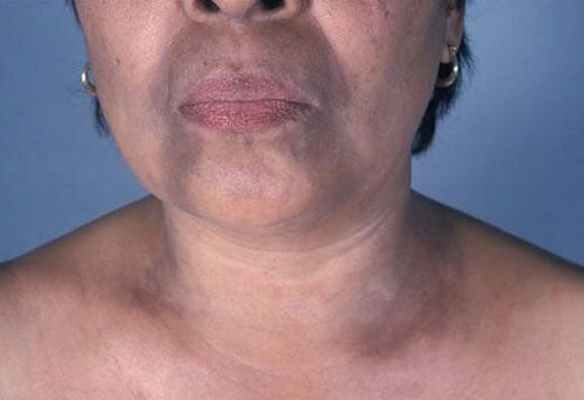 пятна меланоза