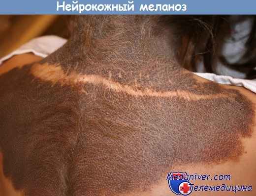 Нейрокожный меланоз - меланобластоз