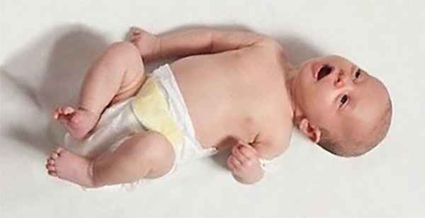 Энцефалопатия новорожденных