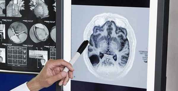 Энцефалопатия новорожденных