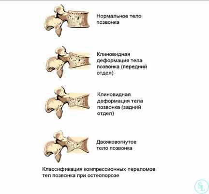 Клиновидные позвонки
