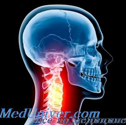 шейный остеохондроз