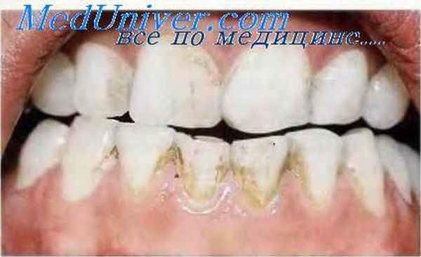 Дисплазия дентина