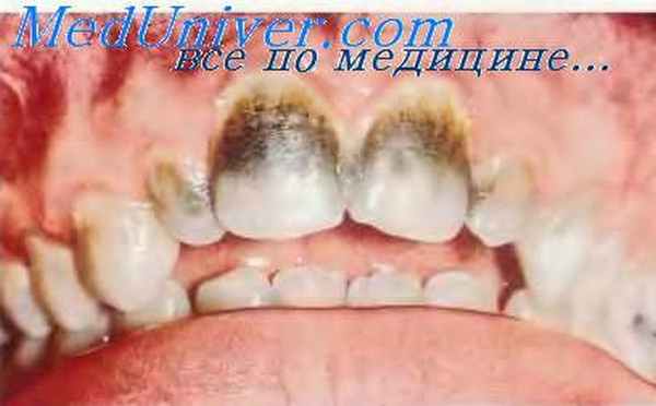 Дисплазия дентина