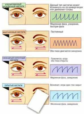 Типы врожденного нистагма