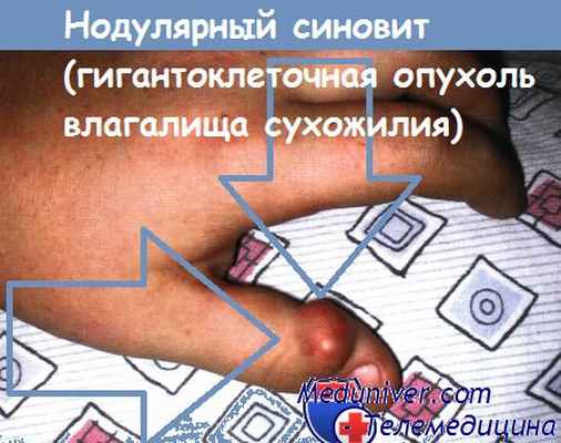 теносиновит