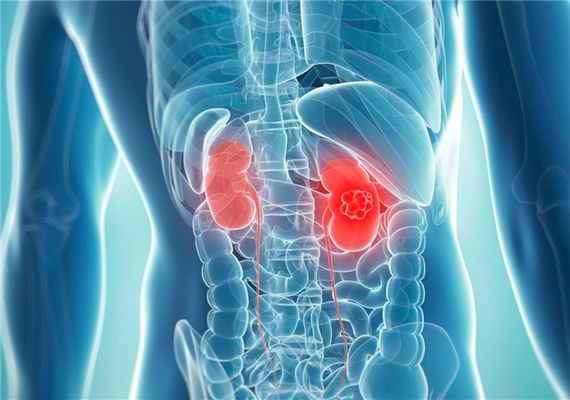 Опухоль (рак) почки: симптомы, стадии и лечение