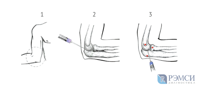 Как делают блокаду локтевого сустава?