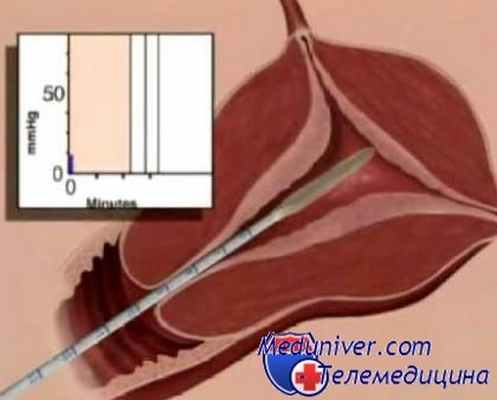 абляция слизистой матки - эндометрия