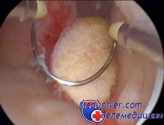 абляция слизистой матки - эндометрия