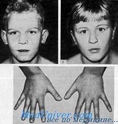 стеноз легочной артерии