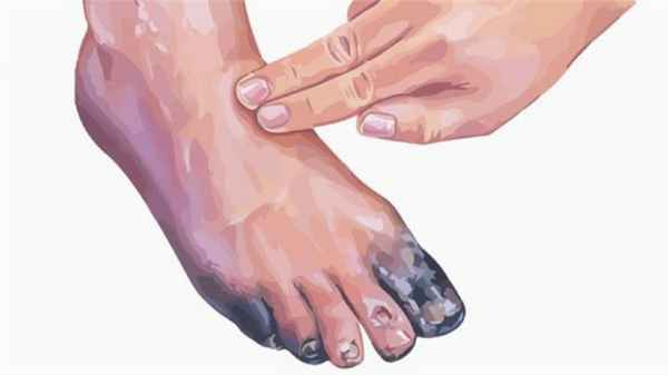 болезнь бюргера лечение в Москве