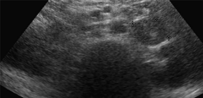 Метастазы в надпочечники