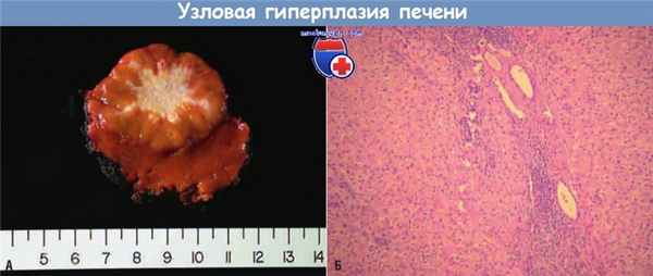 Узловая гиперплазия печени